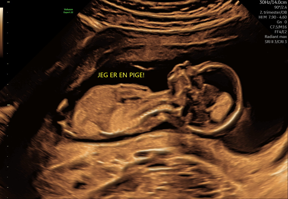 Kønscanning i Hillerød