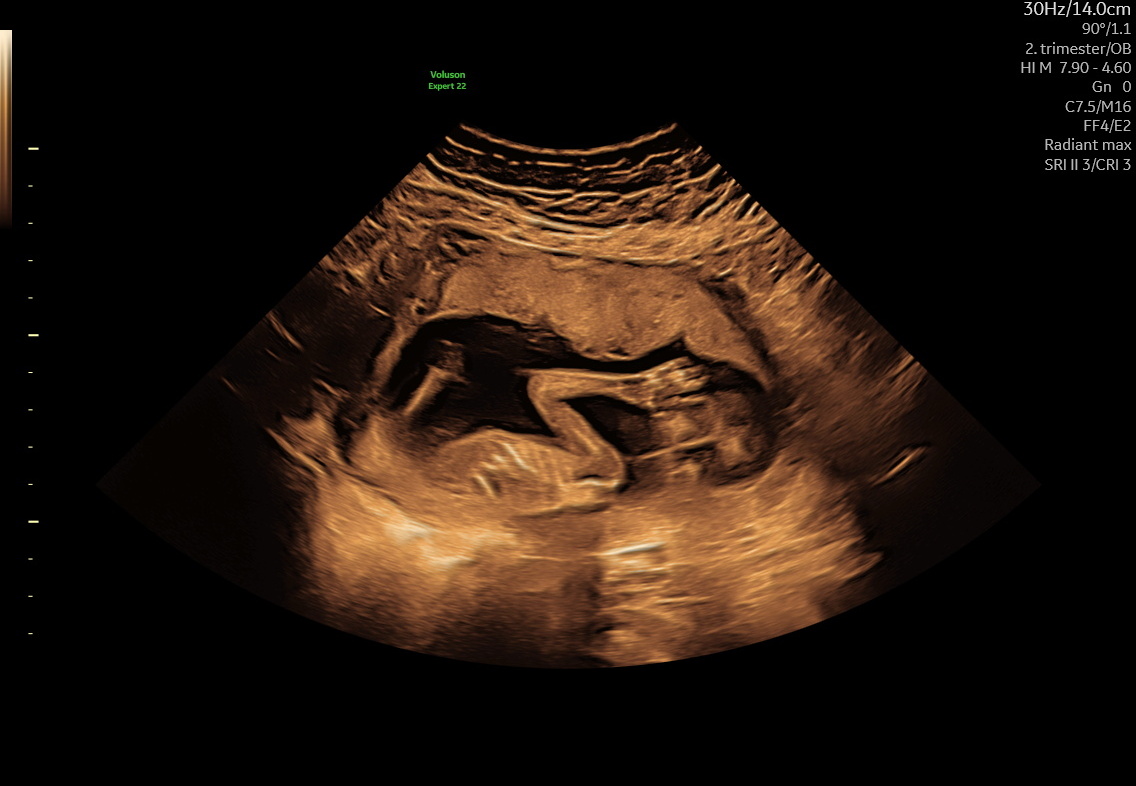Tilvækstscanning i Hillerød